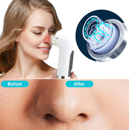 Beauty Blackhead Vacuum Facial - Skincare - HealthCare™